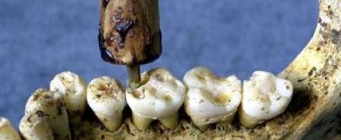 Προϊστορικοί οδοντίατροι και σφραγίσματα 6500 ετών